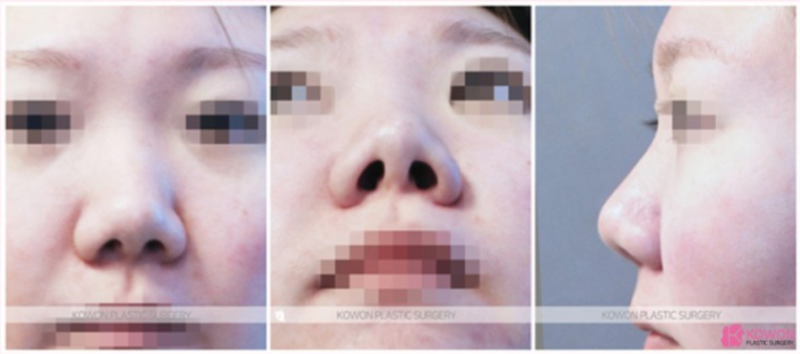 작은코 성형, 짧은 코와 둥근 코끝을 자연스럽게 개선한 코원성형외과 사례 사진 3