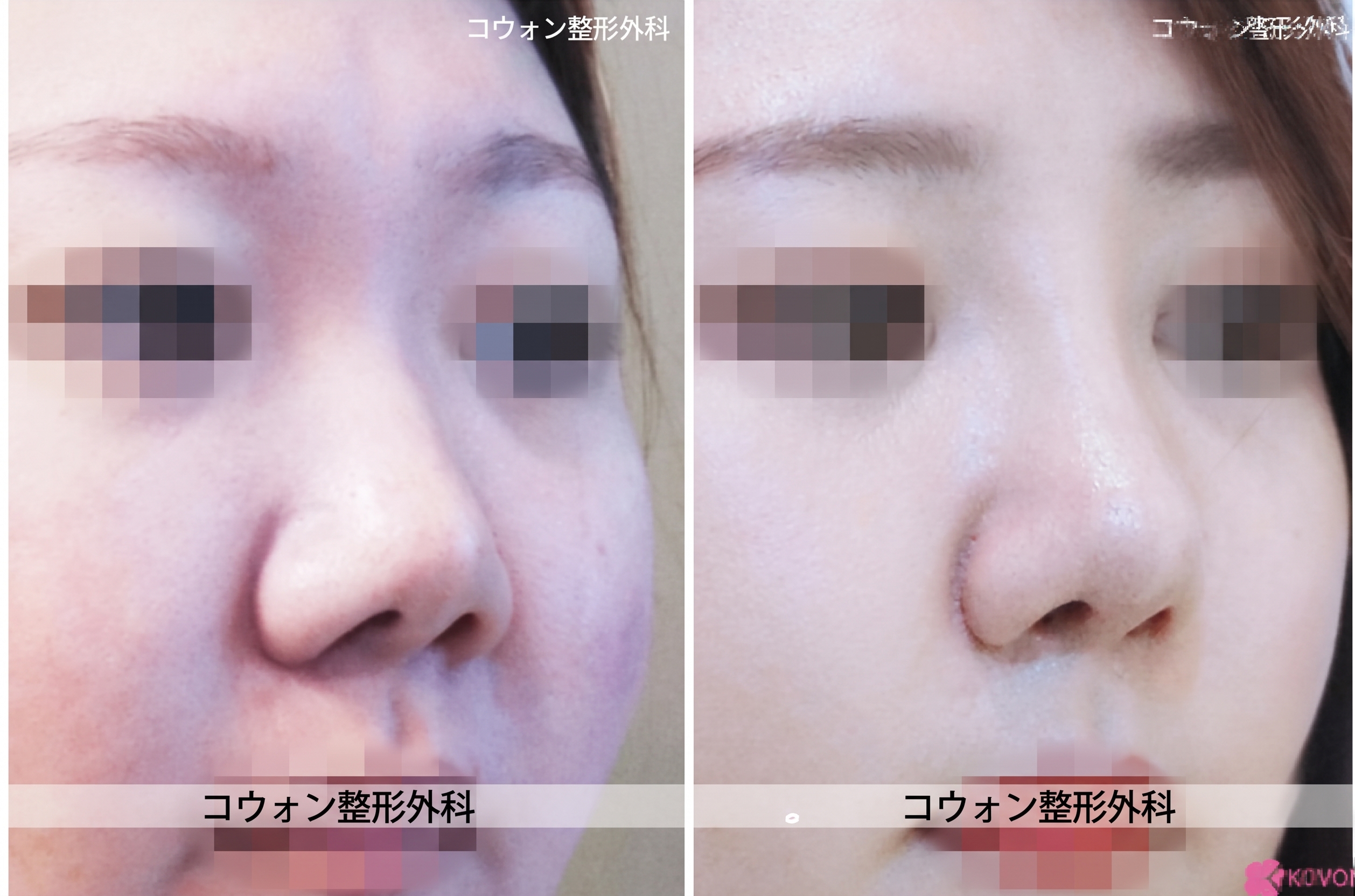 小さい鼻の整形、短い鼻と丸い鼻先を自然に改善したコウォン整形外科の症例 사진 4