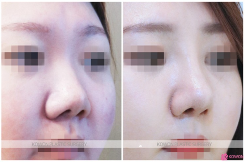 작은코 성형, 짧은 코와 둥근 코끝을 자연스럽게 개선한 코원성형외과 사례 사진 4