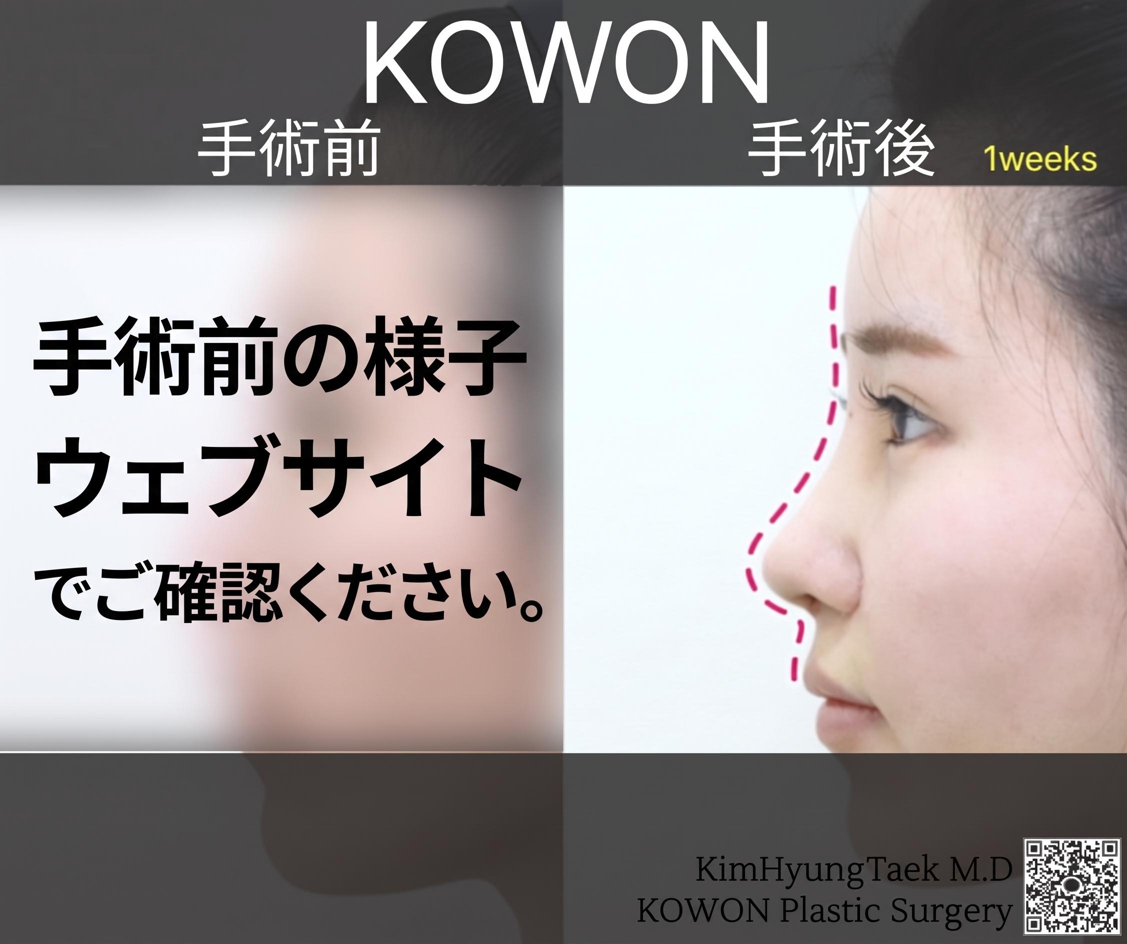長鼻整形、鷲鼻と斜鼻まで同時に改善するコウォン整形外科のノウハウ 사진 3