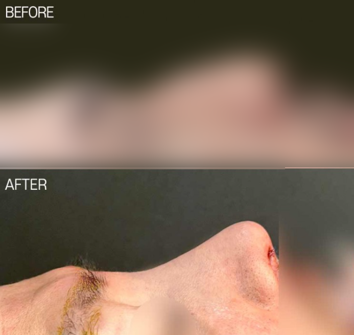 긴코성형, 매부리와 휜코까지 동시에 개선하는 코원성형외과의 노하우