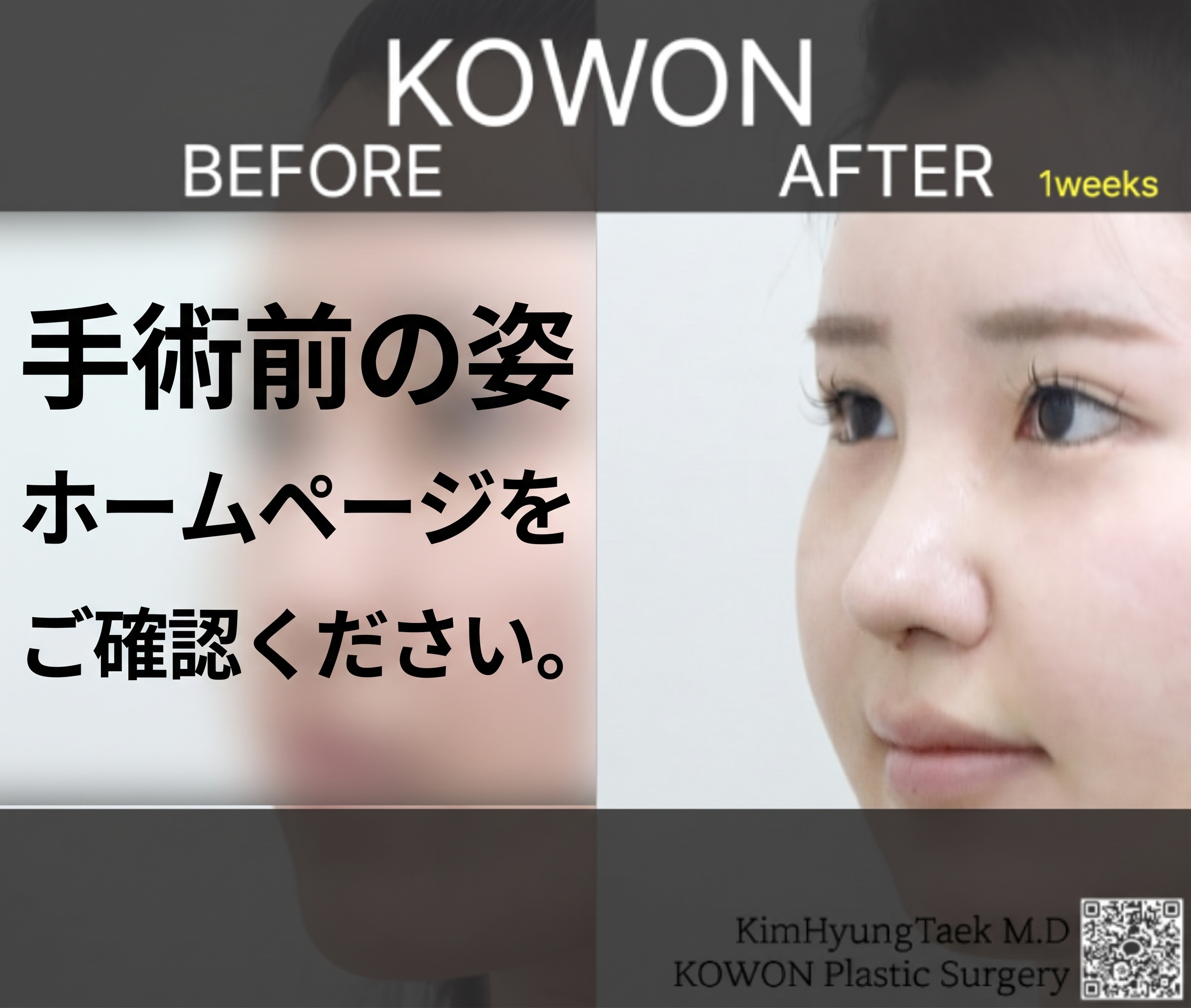 長鼻整形、鷲鼻と斜鼻まで同時に改善するコウォン整形外科のノウハウ 사진 4