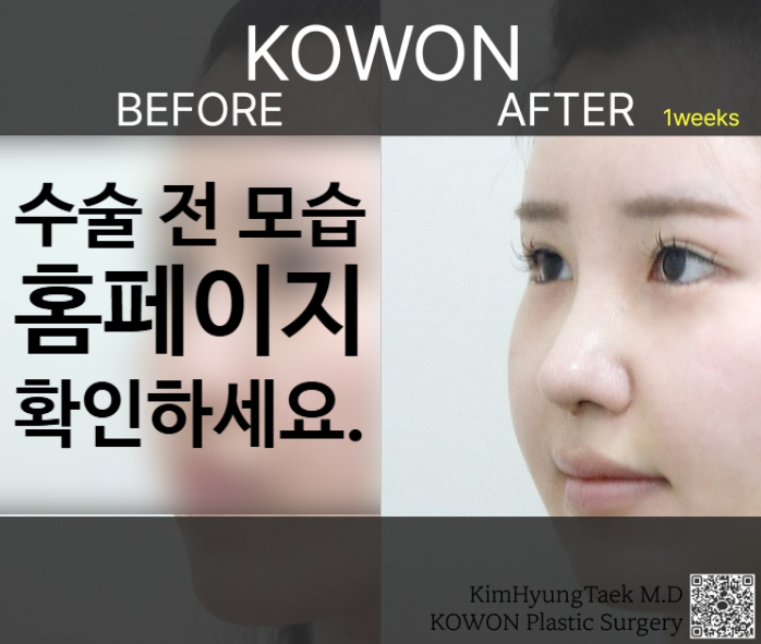 긴코성형, 매부리와 휜코까지 동시에 개선하는 코원성형외과의 노하우 사진 4