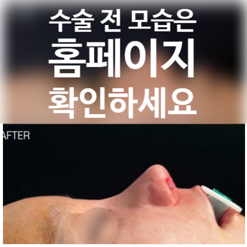 약해진 연골 구조 개선과 코끝 연골재배치로 보는 코재수술 성형외과 성공 사례