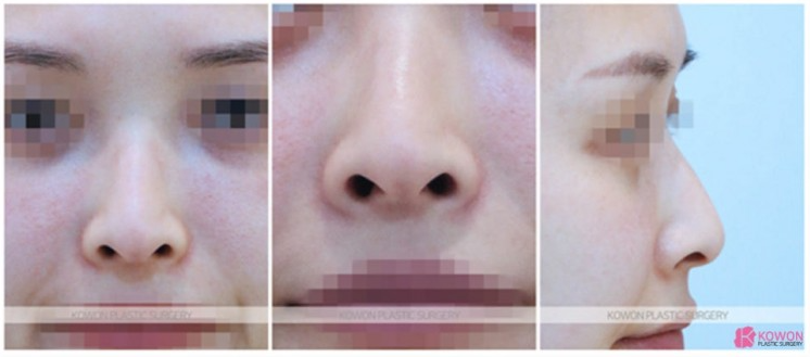 용코 교정 실제 사례로 보는 콧구멍 노출 완화와 세련된 코 라인 사진 3
