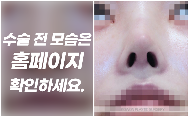 용코 교정 실제 사례로 보는 콧구멍 노출 완화와 세련된 코 라인 사진 4