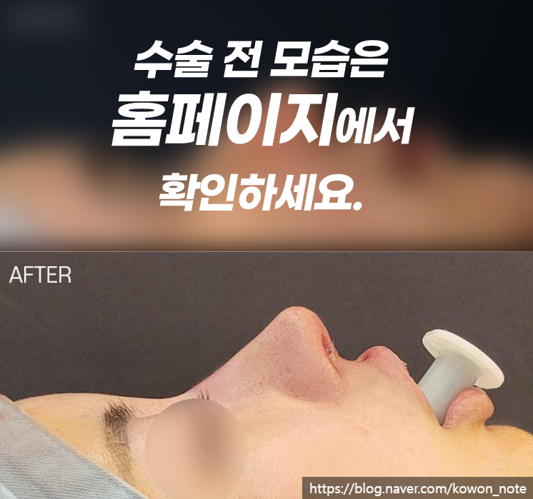 용코 교정 실제 사례로 보는 콧구멍 노출 완화와 세련된 코 라인