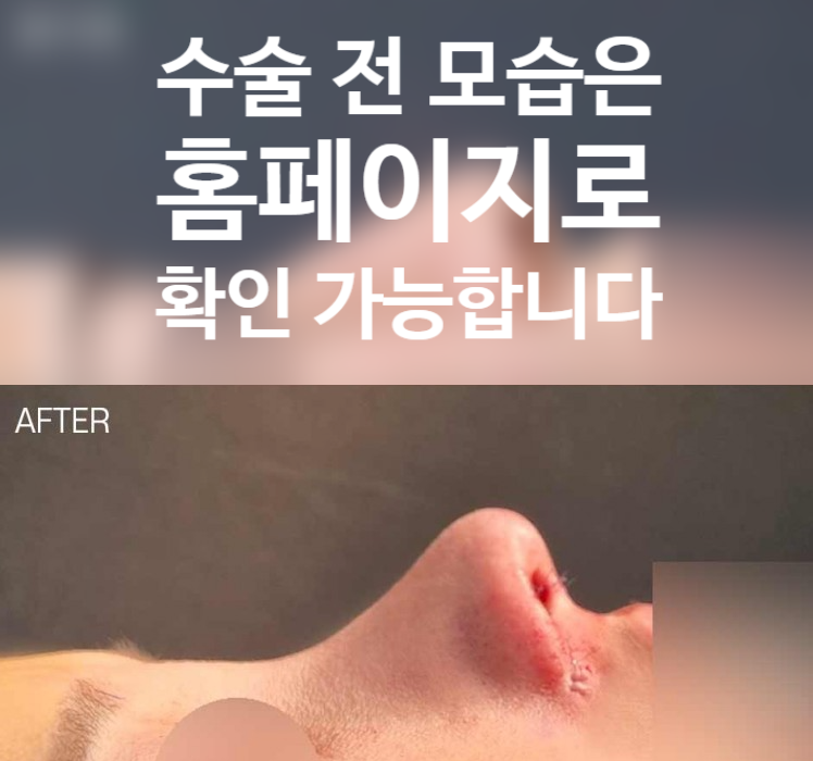 비대칭 콧대와 들린 코끝을 한 번에 잡는 휜코 수술 핵심 정리