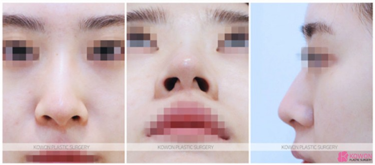 비대칭 콧대와 들린 코끝을 한 번에 잡는 휜코 수술 핵심 정리 사진 3