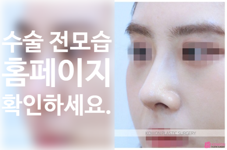 비대칭 콧대와 들린 코끝을 한 번에 잡는 휜코 수술 핵심 정리 사진 4