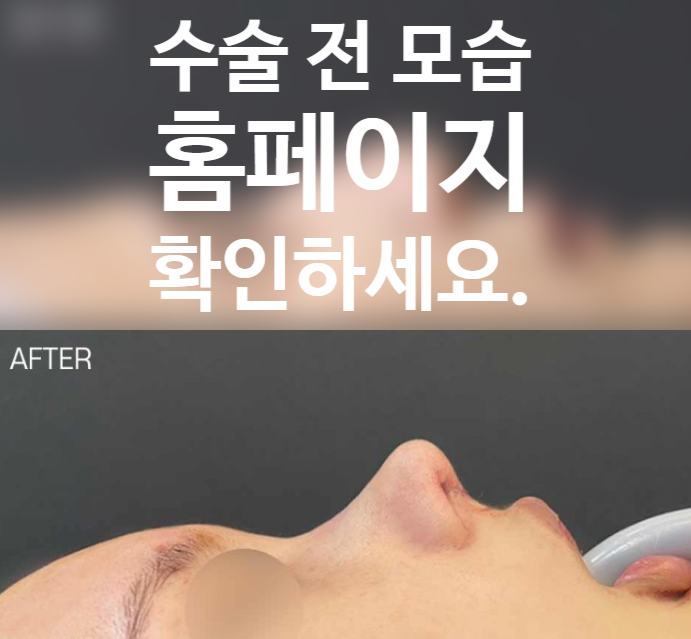 매부리 개선과 코끝 묶기 과정을 통해 완성된 코원성형외과의 자려한 라인 변화