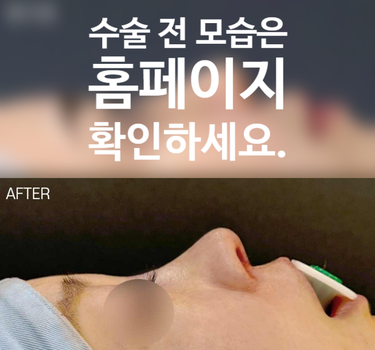 낮은코 성형 과하지 않은 높이와 부드러운 라인을 고려한 코원성형외과 사례