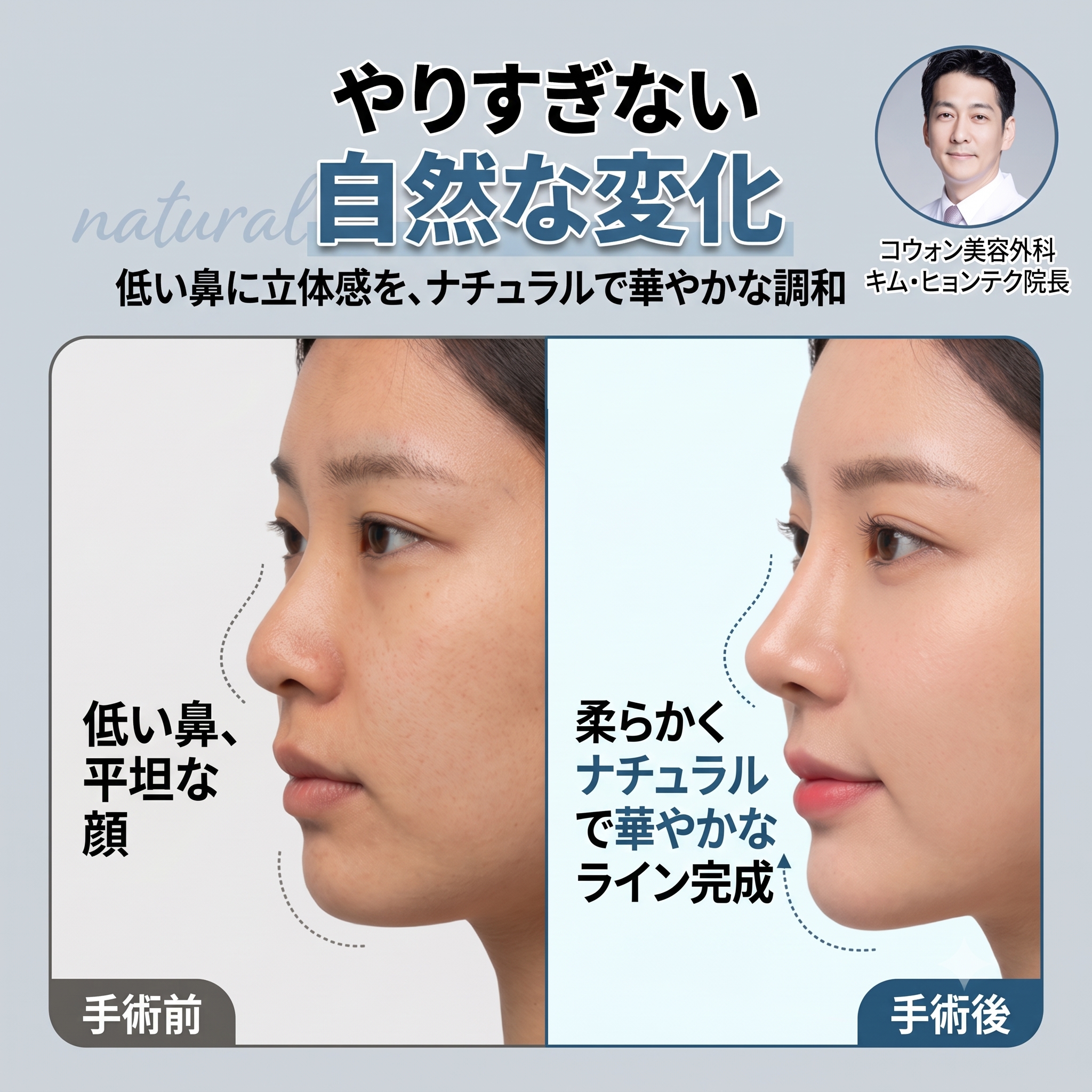 低い鼻の整形｜過度でない高さとなめらかなラインを考慮したコウォン形成外科の症例