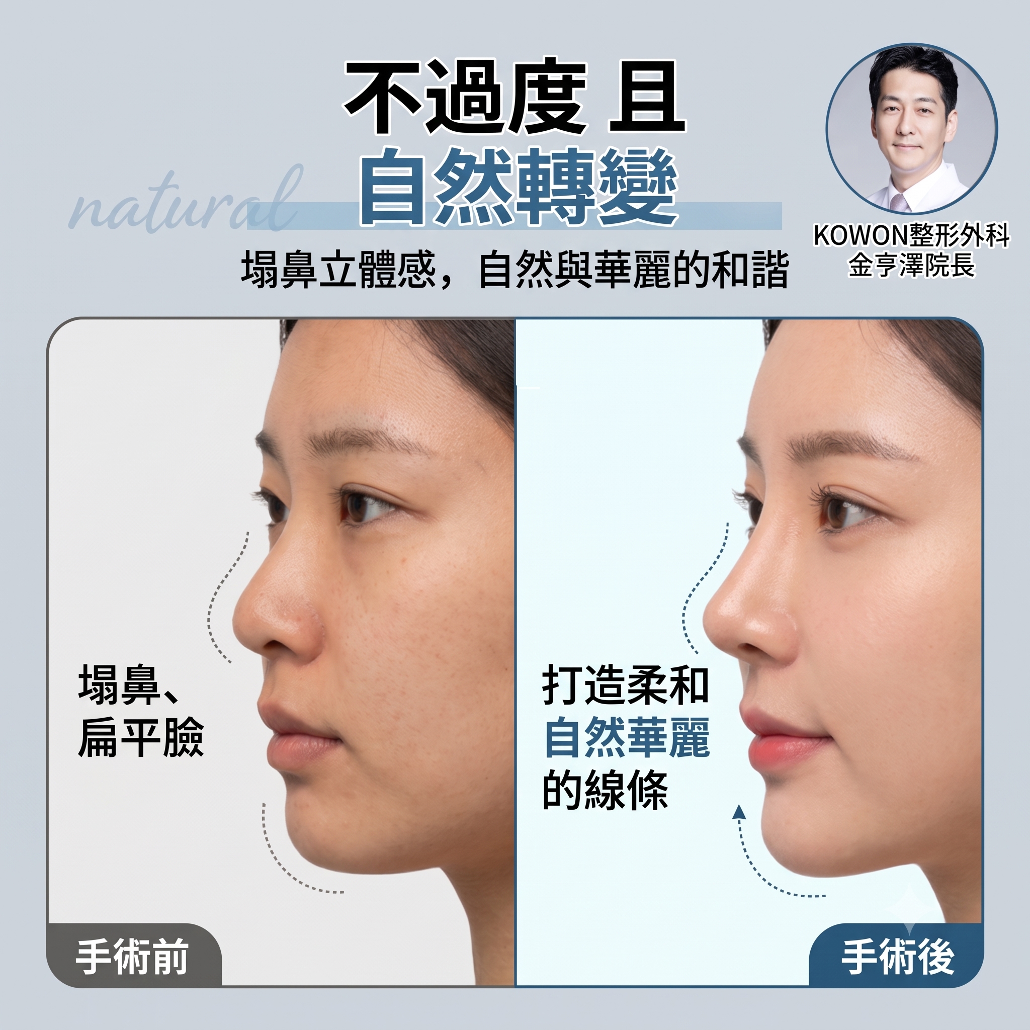 低鼻隆鼻案例｜兼顧不過度的鼻高與柔和線條，Kowon整形外科分享