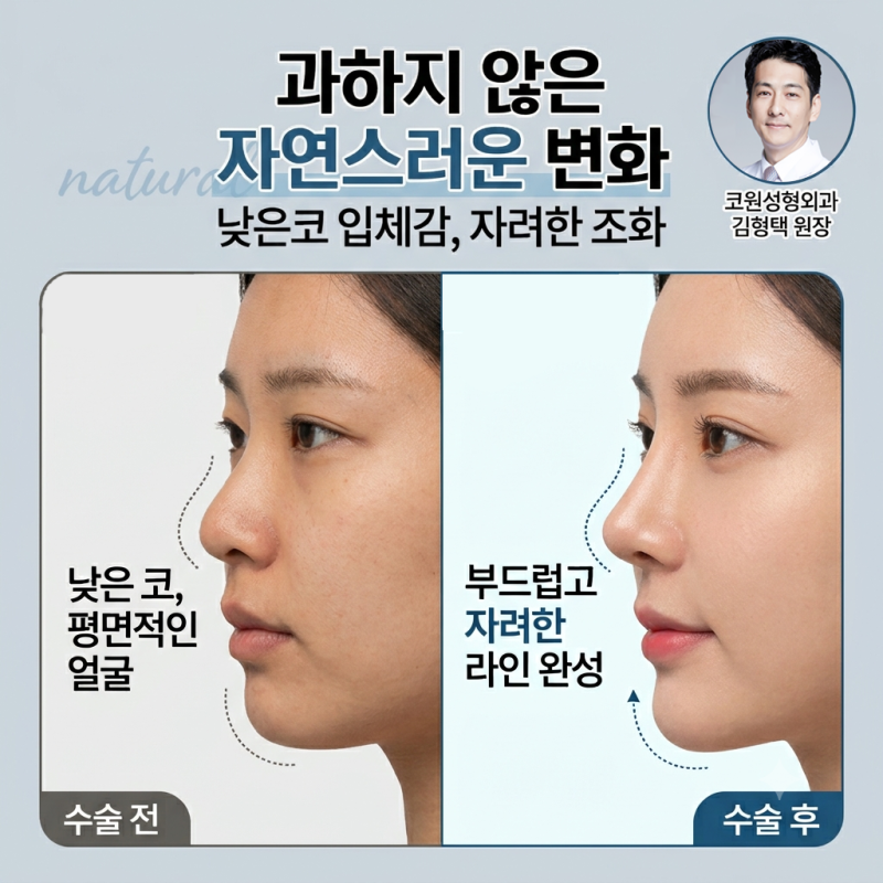 낮은코 성형 과하지 않은 높이와 부드러운 라인을 고려한 코원성형외과 사례