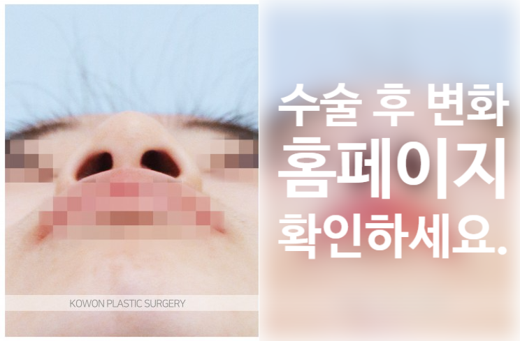 낮은코 성형 과하지 않은 높이와 부드러운 라인을 고려한 코원성형외과 사례 사진 3