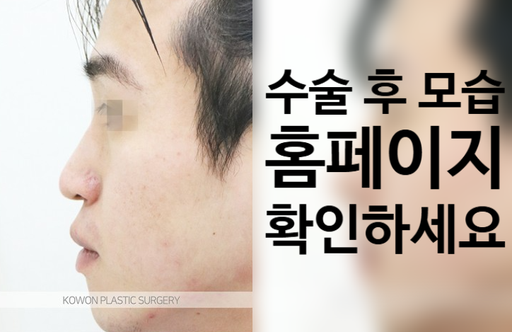 코원성형외과 리브핏으로 완성하는 남자 코끝 성형 및 콧대 라인 교정 사진 3