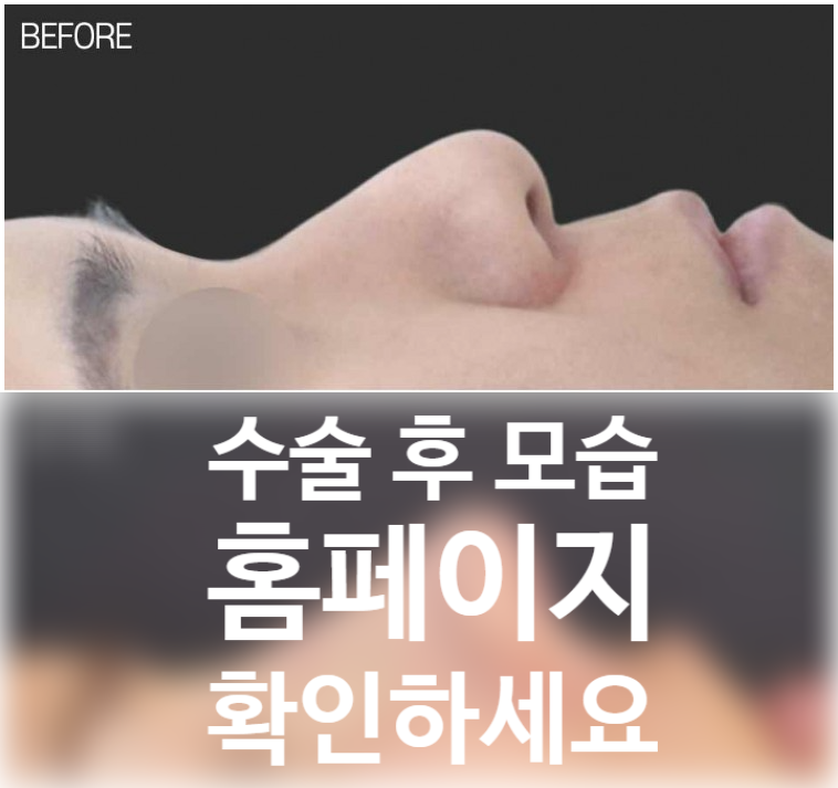 코원성형외과 리브핏으로 완성하는 남자 코끝 성형 및 콧대 라인 교정
