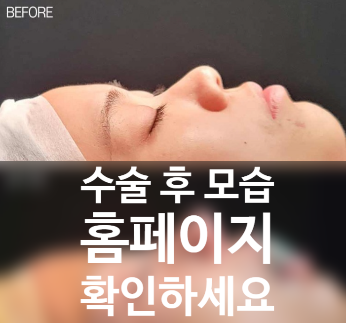퍼진코수술 전후 입체감 비교와 코원성형외과 중안면부 개선 노하우
