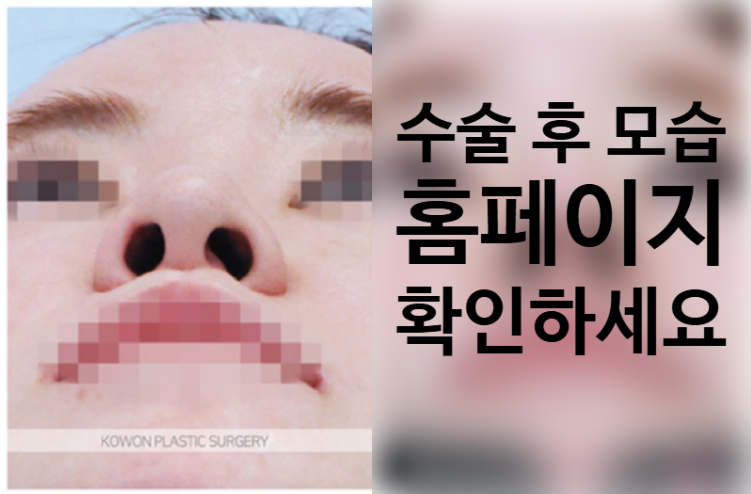 퍼진코수술 전후 입체감 비교와 코원성형외과 중안면부 개선 노하우 사진 3