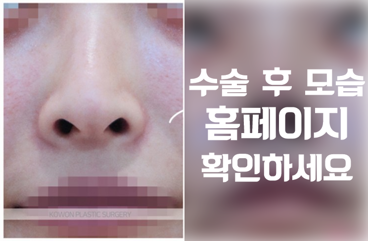 콧대부터 콧날개까지! 자연스러운 실루엣을 만드는 매부리코성형 핵심 포인트 사진 4