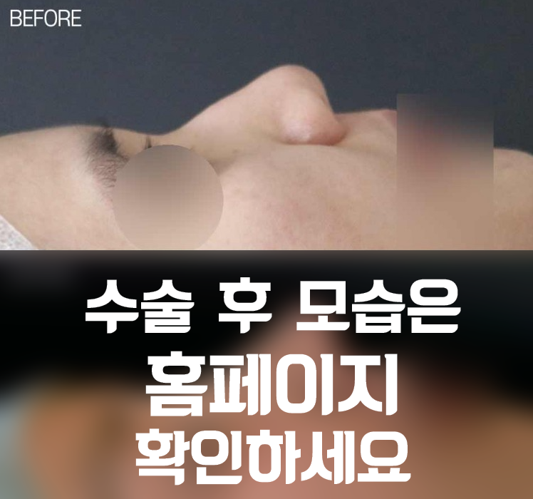콧대부터 콧날개까지! 자연스러운 실루엣을 만드는 매부리코성형 핵심 포인트