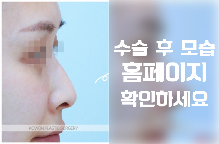 콧대부터 콧날개까지! 자연스러운 실루엣을 만드는 매부리코성형 핵심 포인트 사진 3