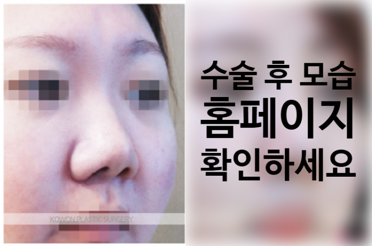 짧은코 성형, 콧대 높이부터 코끝 지지대까지 정교하게 다듬는 코원성형외과 노하우 사진 4