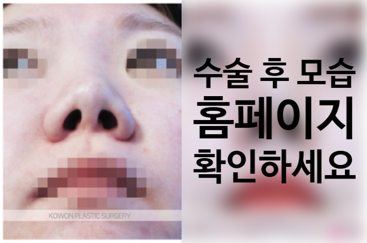 짧은코 성형, 콧대 높이부터 코끝 지지대까지 정교하게 다듬는 코원성형외과 노하우 사진 3