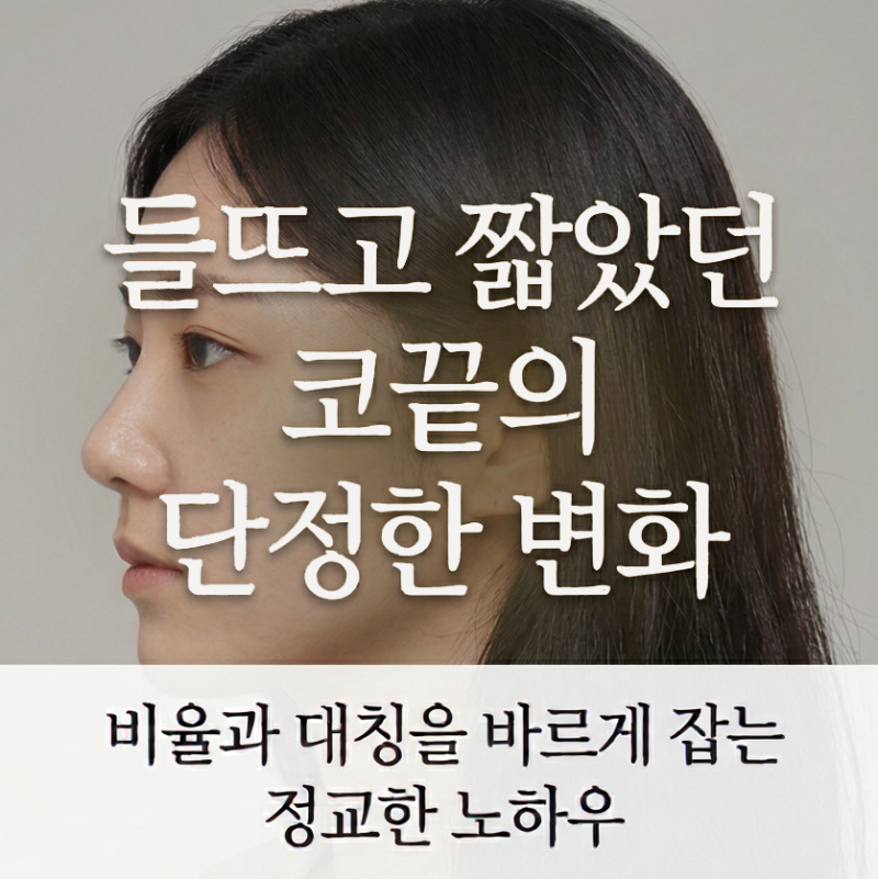 짧은코 성형, 콧대 높이부터 코끝 지지대까지 정교하게 다듬는 코원성형외과 노하우
