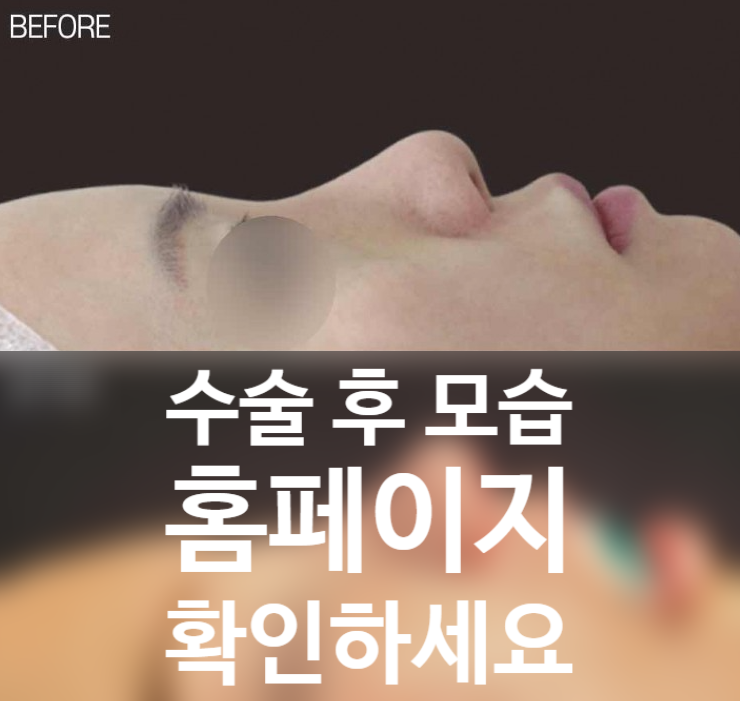 보형물 없이 입매까지 세련되게, 무보형물 코끝수술의 정석! [코원성형외과]