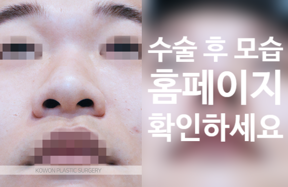 보형물 없이 입매까지 세련되게, 무보형물 코끝수술의 정석! [코원성형외과] 사진 3