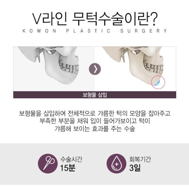 꿈꾸던 V라인, 어렵지 않아요! 무턱보형물수술