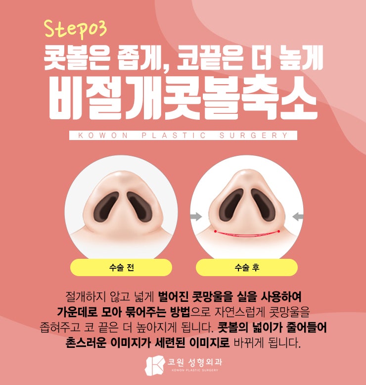 여자매부리코 자연스러운 개선을 원한다면 CLICK 사진 4