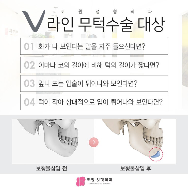 무턱수술잘하는곳 알아볼 때 유의해야는 점 사진 4