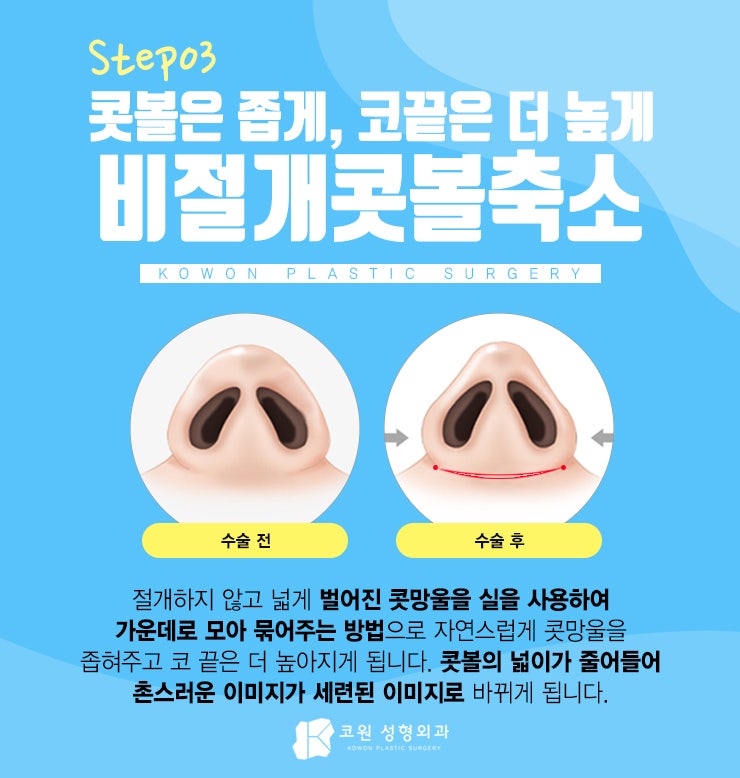 압구정코재수술 필요한 분이라면 사진 4