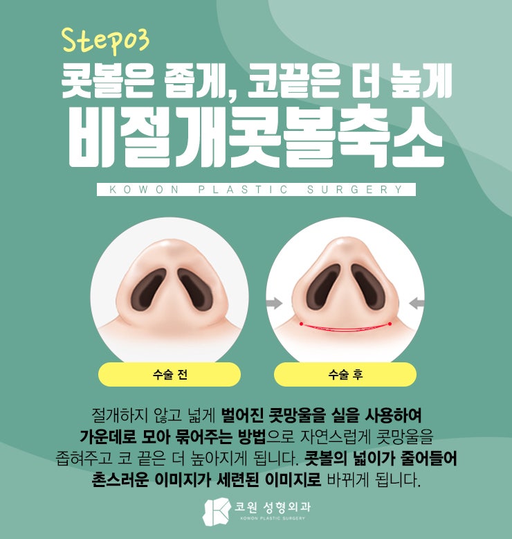 낮은코수술후기 꼼꼼히 확인하세요! 사진 4