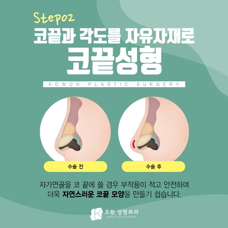 낮은코수술후기 꼼꼼히 확인하세요! 사진 3