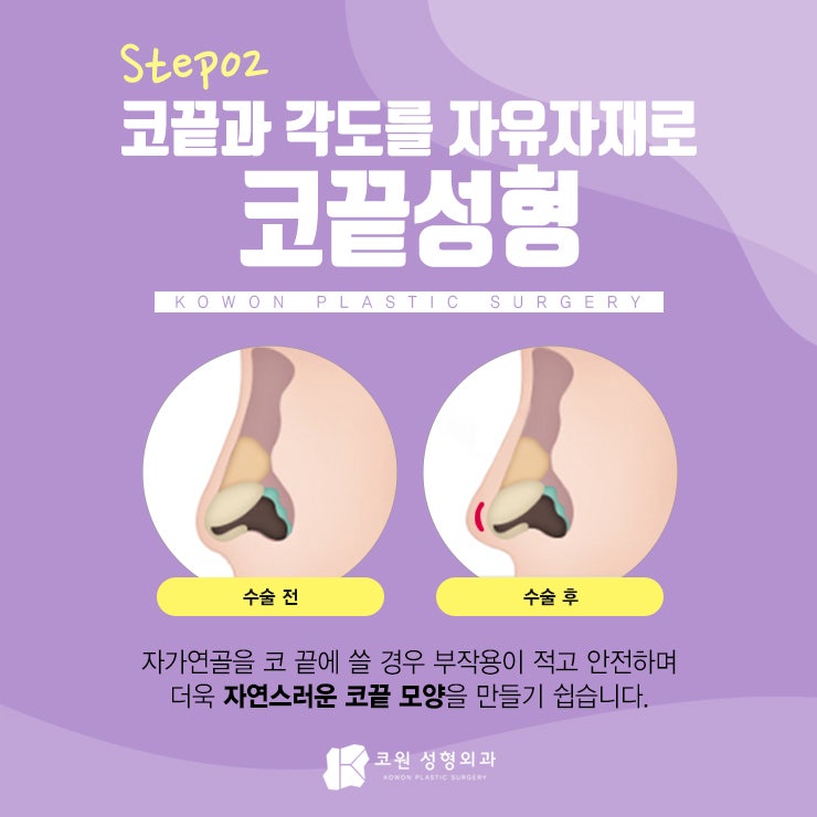매부리코수술 만족스러운 결과는 사진 3