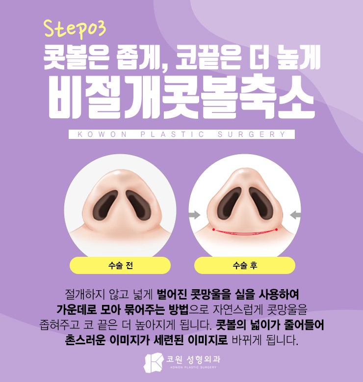 강남코재수술추천 3STEP코성형으로 끝내요 사진 4