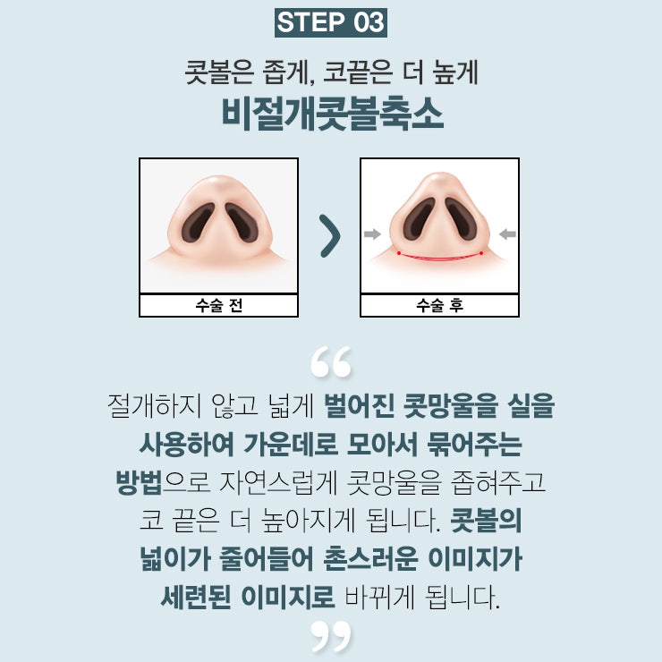 휜코수술전후 3STEP으로 끝내기 사진 4