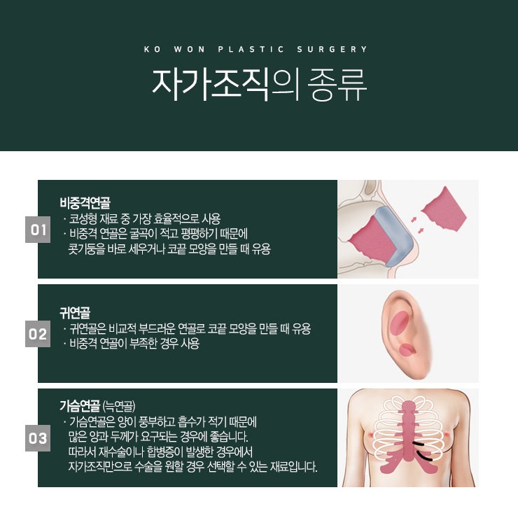 매부리코성형후기 무보형물코성형으로 사진 5