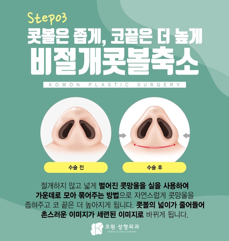 압구정코성형추천 올바르게 선택해보세요! 사진 4