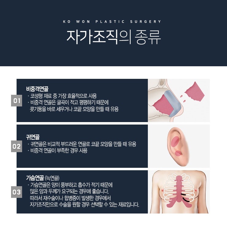 여자매부리코성형 '무보형물'로 가능해 사진 3