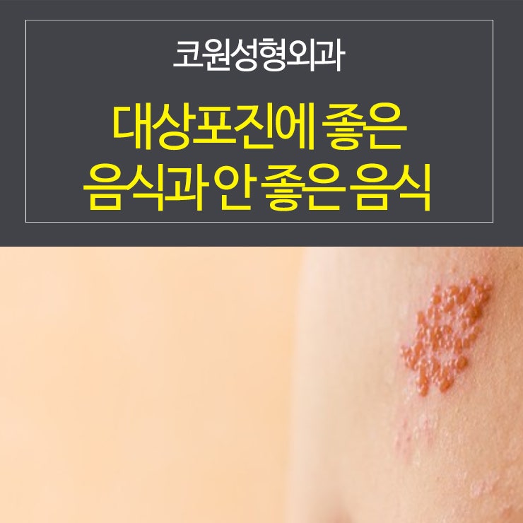 대상포진에 좋은 음식과 안 좋은 음식