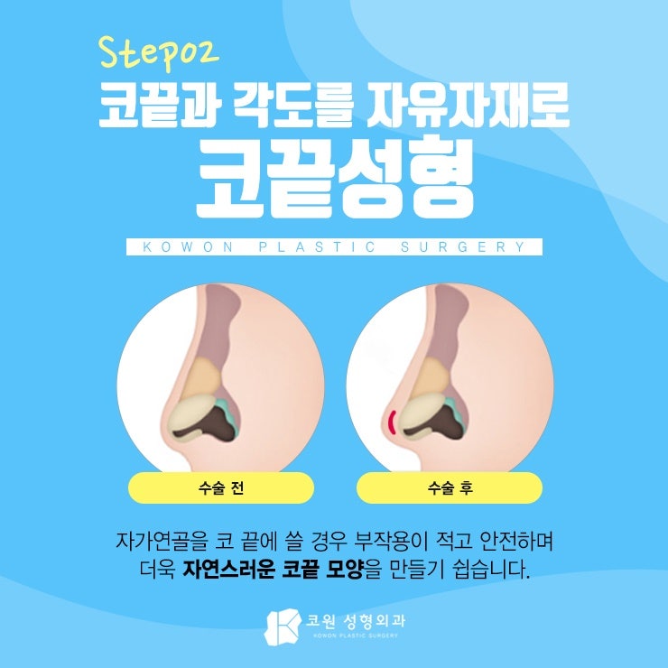 휜코성형가격 부담 덜고 만족스럽게! 사진 3