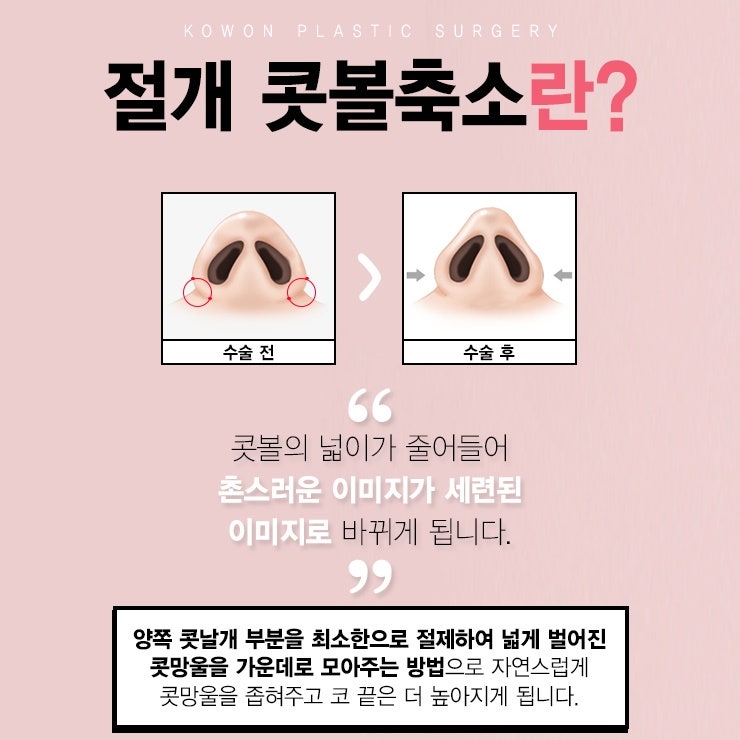 주먹코성형 '복코솔루션'으로 개선 가능해 사진 4