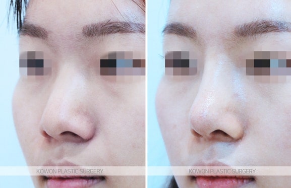 여자복코수술 콧등절골술이 필요한 경우 사진 4