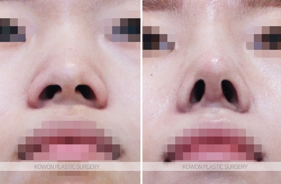 여자복코수술 콧등절골술이 필요한 경우 사진 6