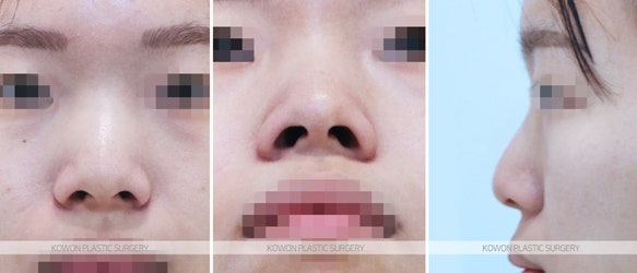 여자복코수술 콧등절골술이 필요한 경우